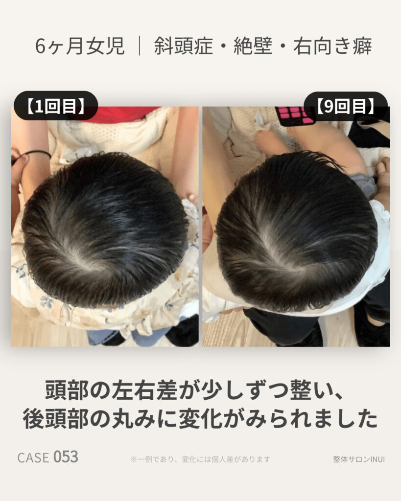 生後6ヶ月女児の斜頭症ビフォーアフター比較