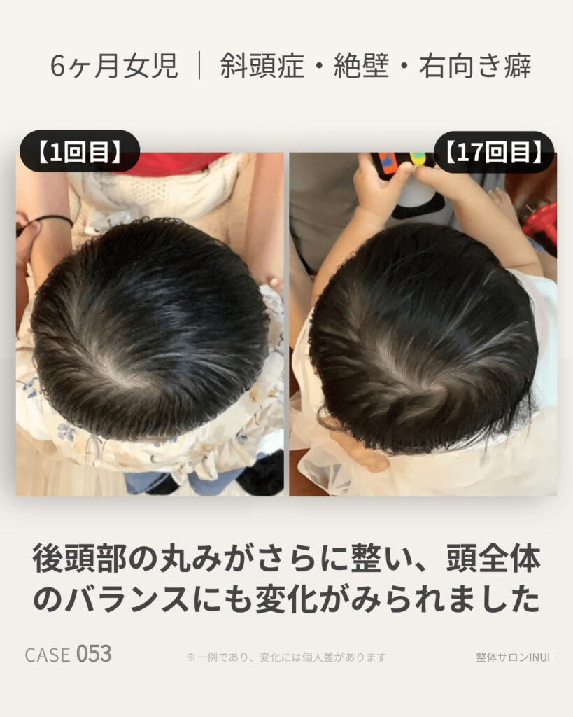 生後6ヶ月女児の斜頭症ビフォーアフター比較