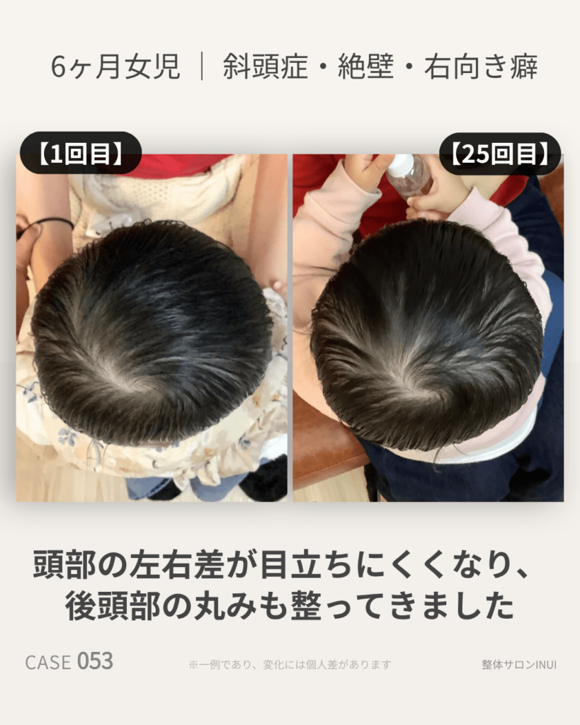 生後6ヶ月女児の斜頭症ビフォーアフター比較