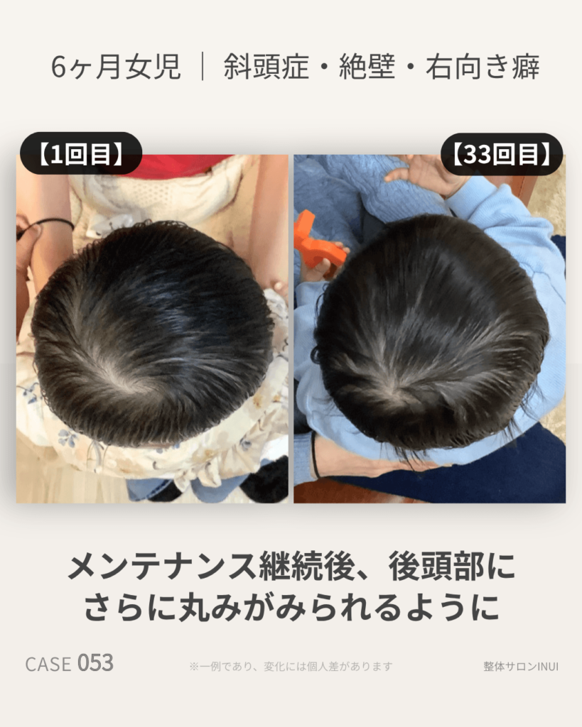 生後6ヶ月女児の斜頭症ビフォーアフター比較