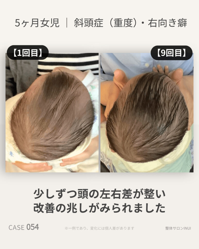 生後5ヶ月女児の斜頭症ビフォーアフター比較