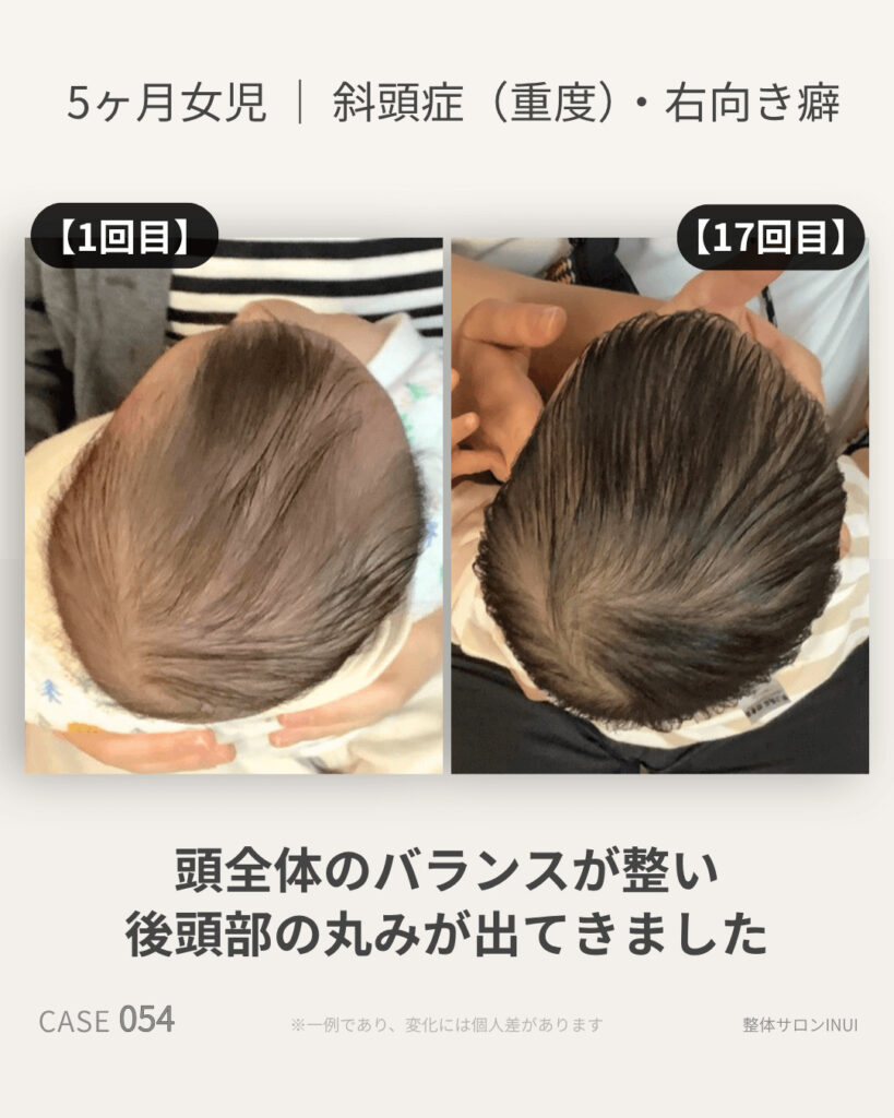 生後5ヶ月女児の斜頭症ビフォーアフター比較