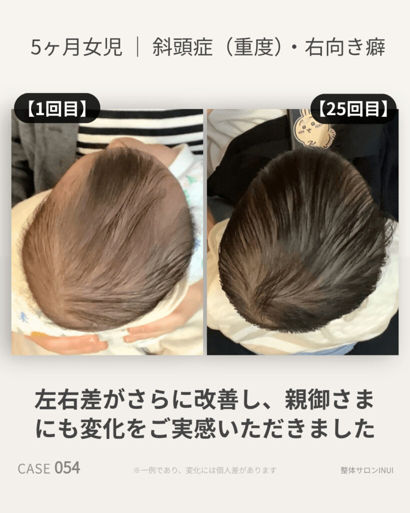 生後5ヶ月女児の斜頭症ビフォーアフター比較