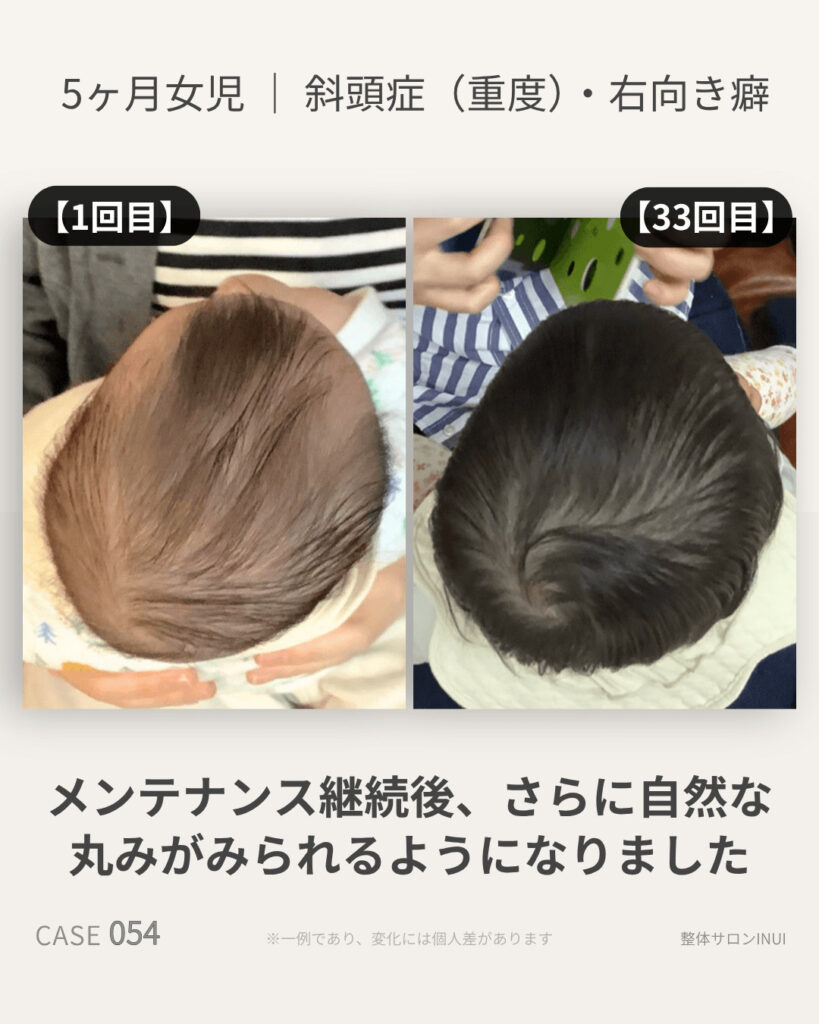 生後5ヶ月女児の斜頭症ビフォーアフター比較