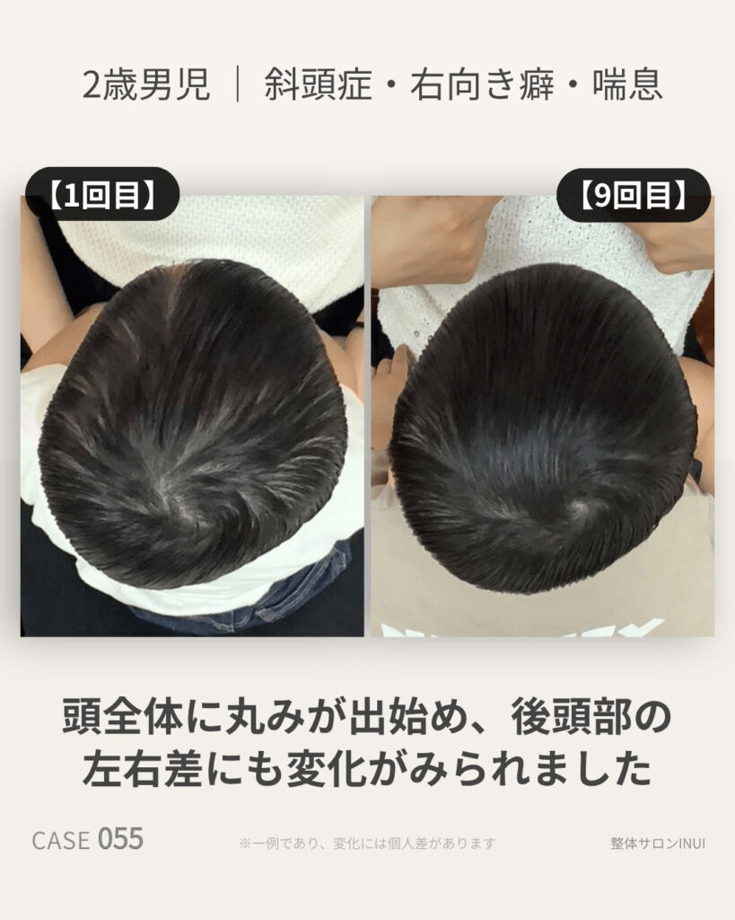 2歳男児の斜頭症ビフォーアフター比較