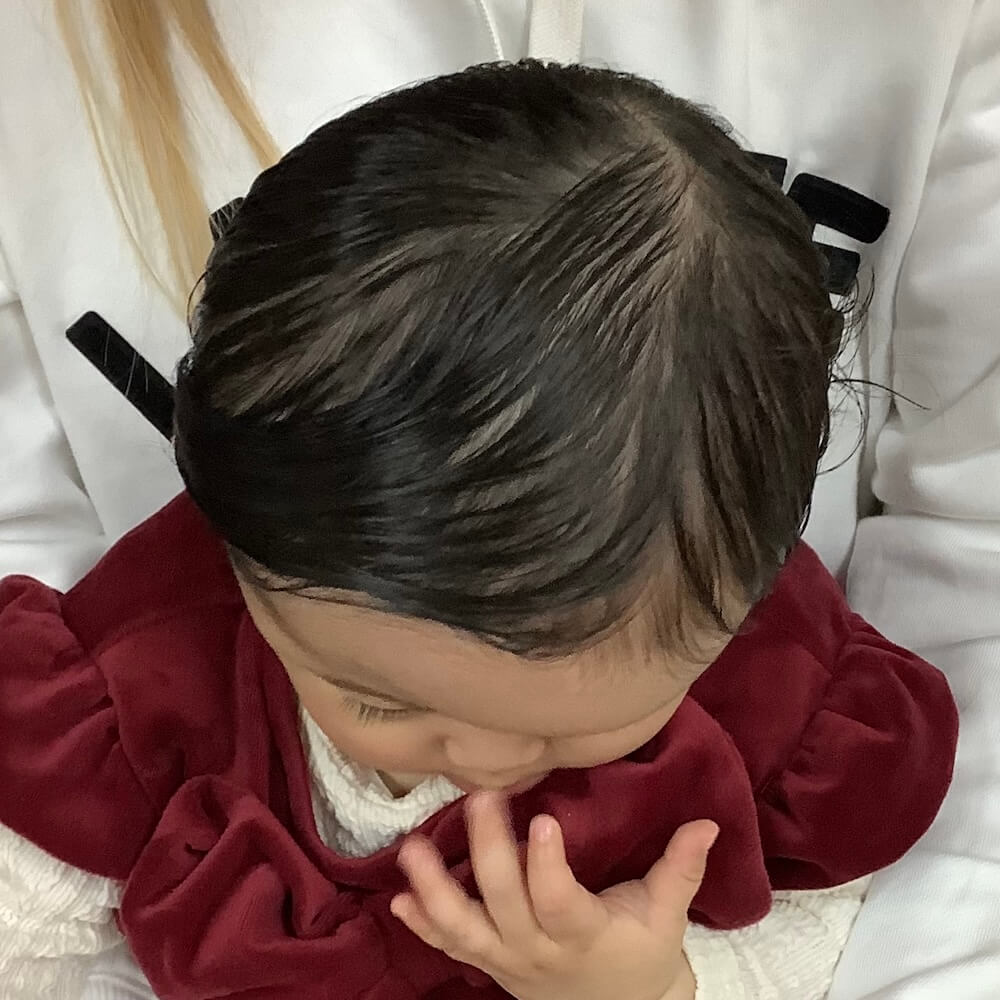 斜頭症によるおでこの左右差がみられる赤ちゃん