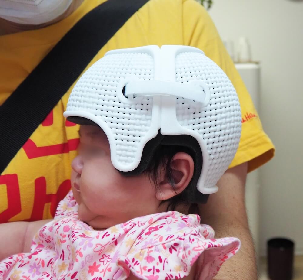 ヘルメット治療を受けている赤ちゃん