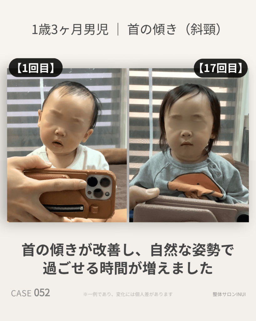 1歳3ヶ月男児の首の傾き(斜頸)の施術前後の比較写真