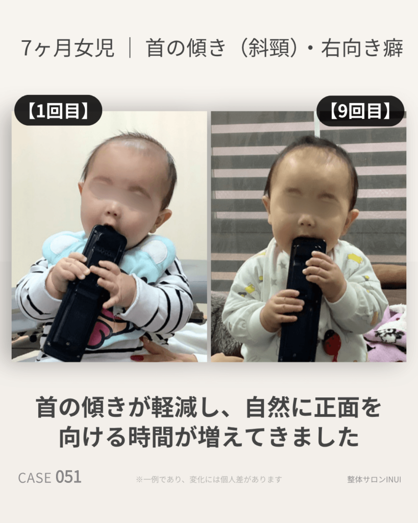 生後7ヶ月女児の首の傾き(斜頸)の施術前後の比較写真