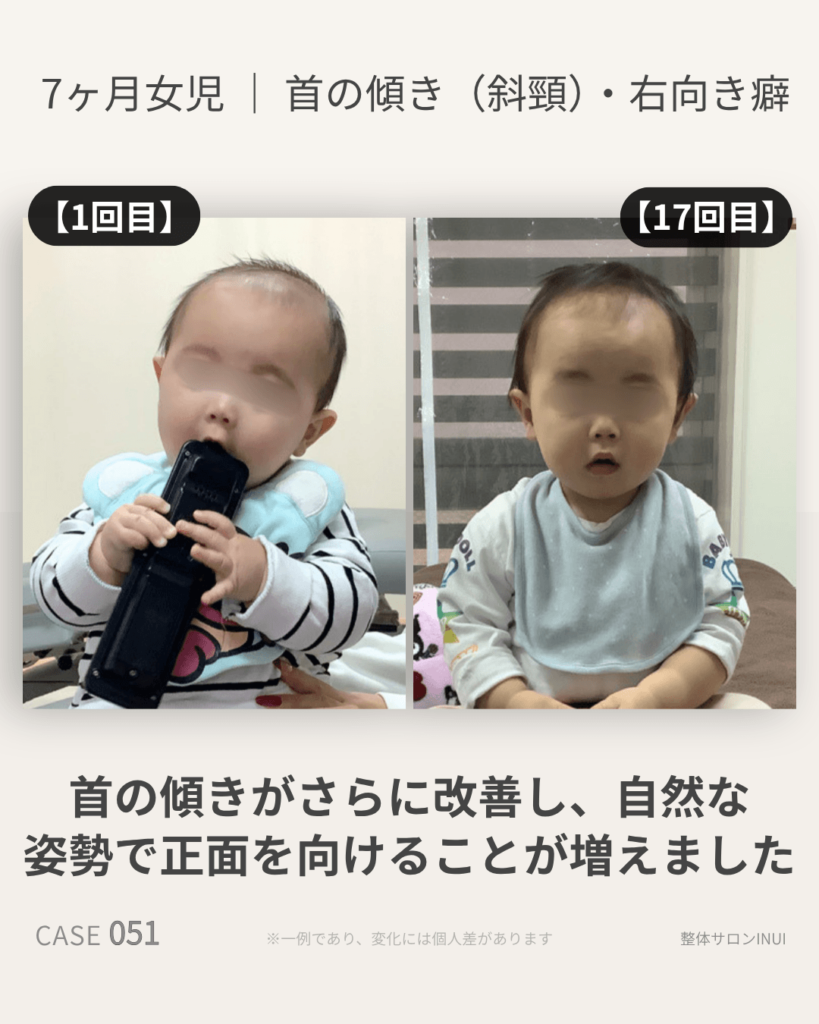 生後7ヶ月女児の首の傾き(斜頸)の施術前後の比較写真
