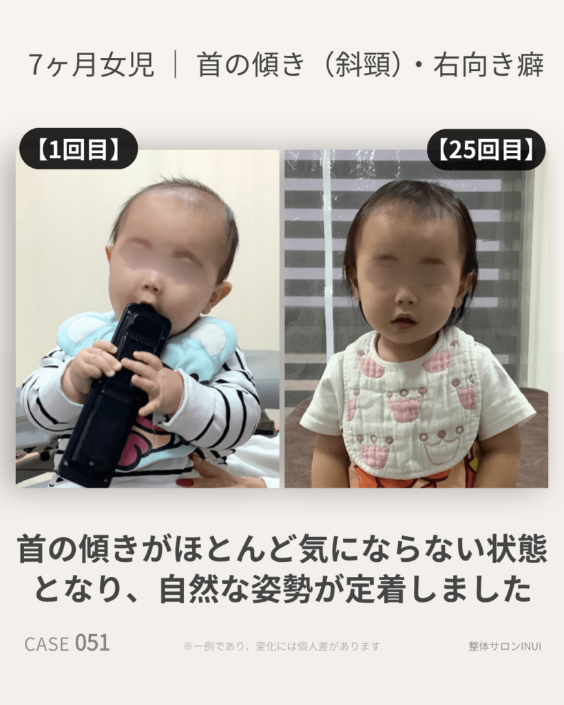 生後7ヶ月女児の首の傾き(斜頸)の施術前後の比較写真