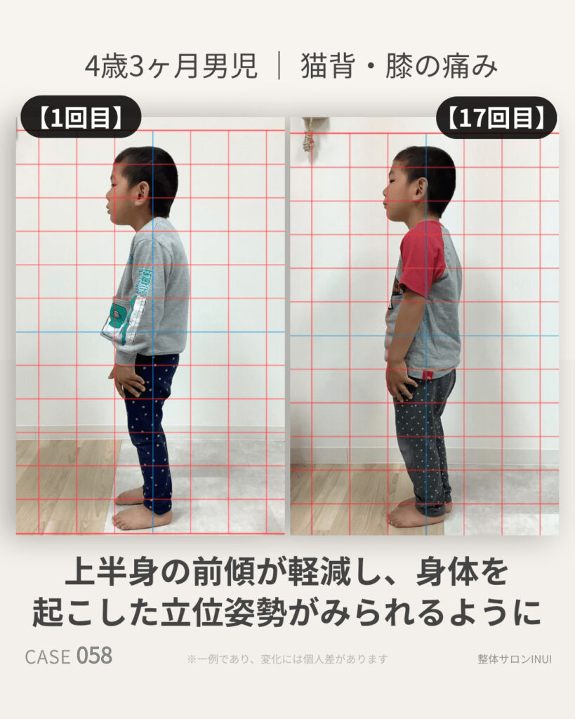 4歳3ヶ月男児の猫背・姿勢不良の17回目来院時