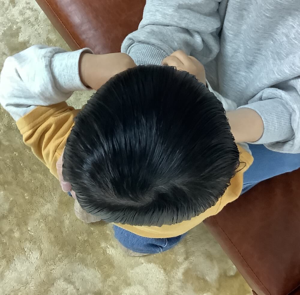 2歳4ヶ月男児の絶壁頭による後頭部の平坦感