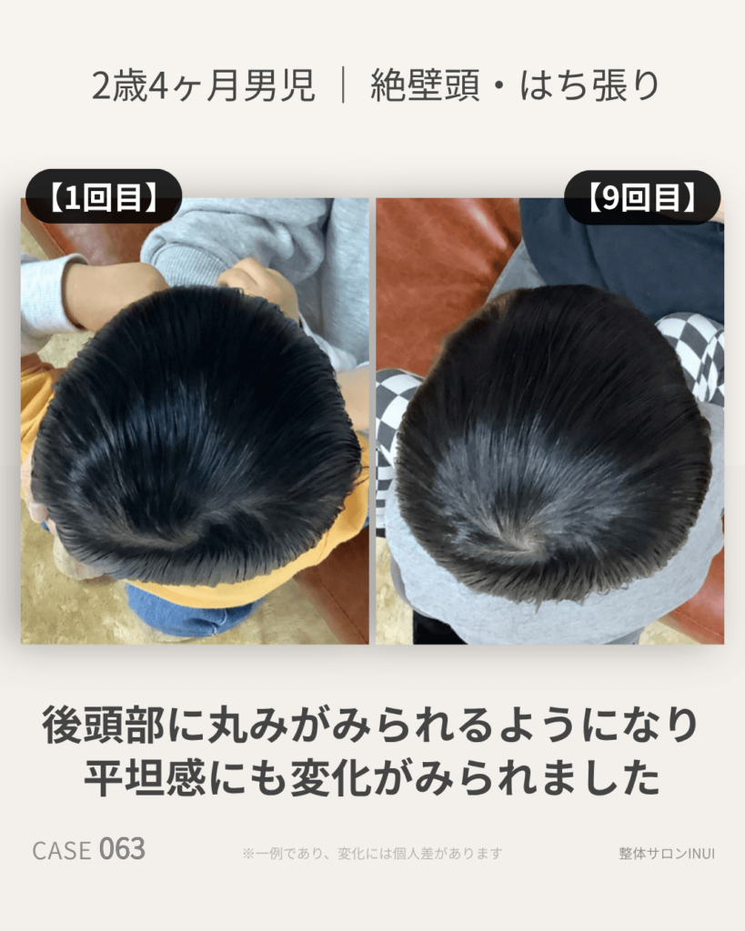 2歳4ヶ月男児の絶壁頭ビフォーアフター比較