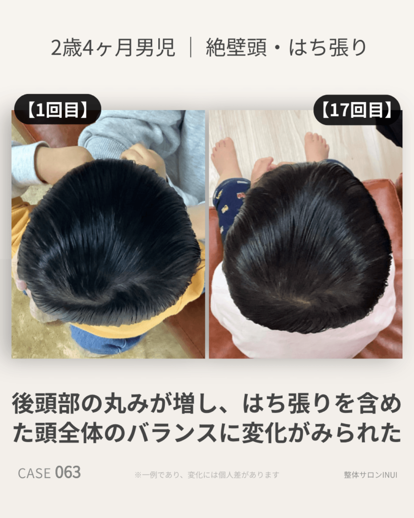 2歳4ヶ月男児の絶壁頭ビフォーアフター比較