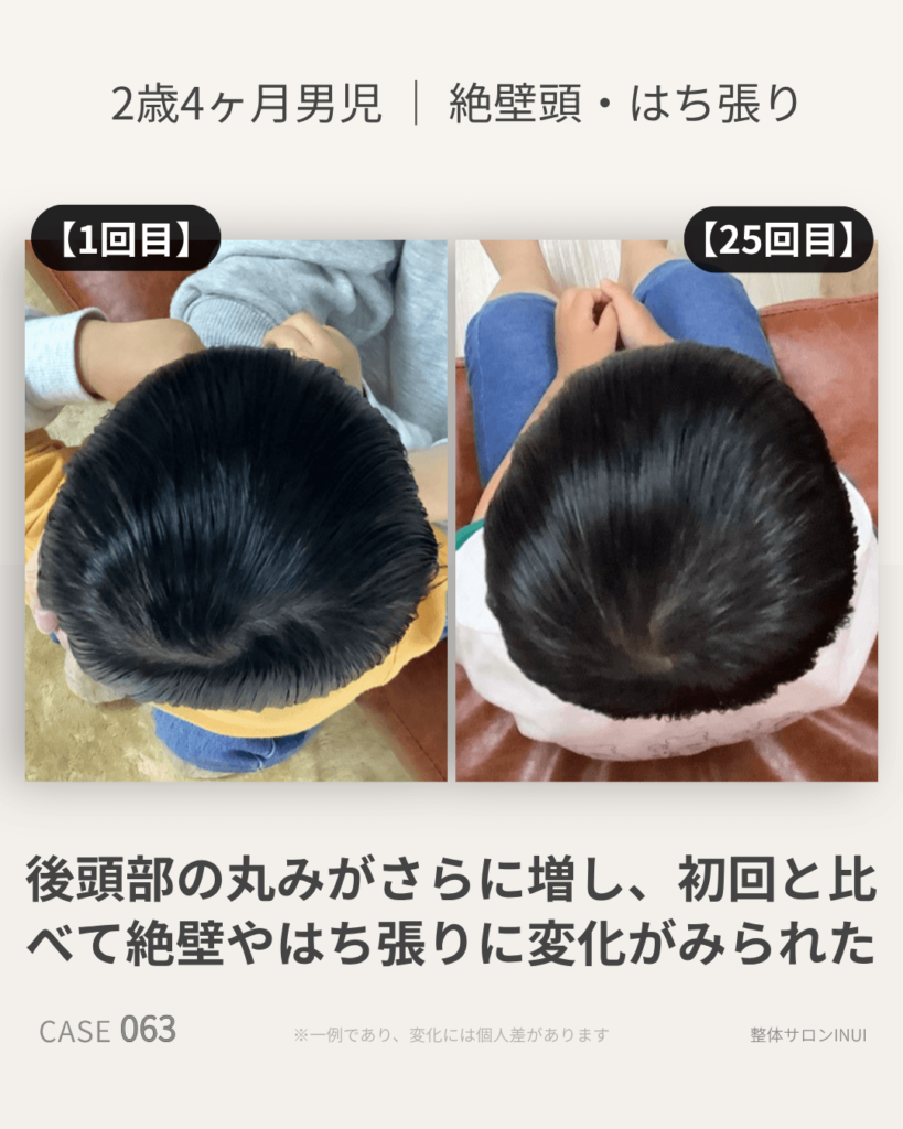 2歳4ヶ月男児の絶壁頭ビフォーアフター比較