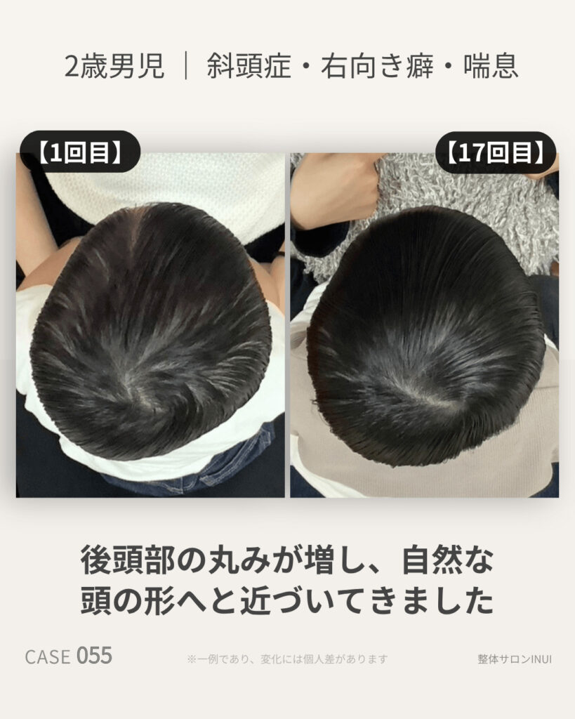 2歳男児の斜頭症ビフォーアフター比較