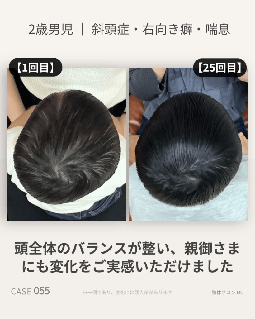 2歳男児の斜頭症ビフォーアフター比較
