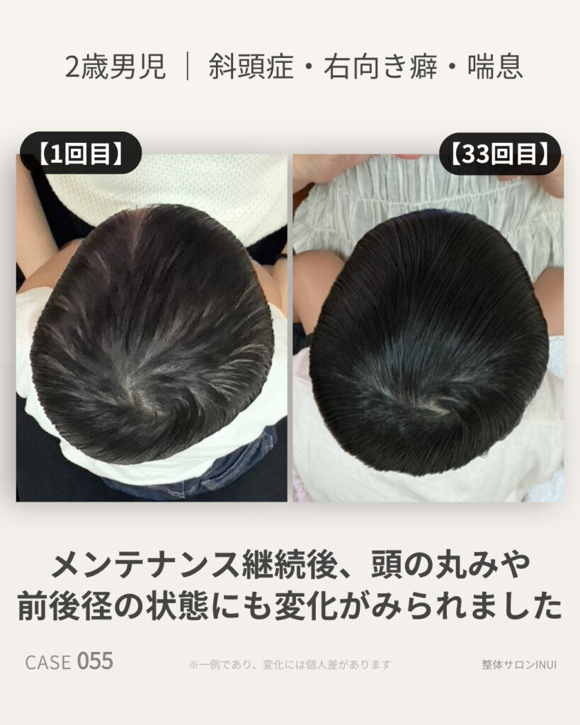 2歳男児の斜頭症ビフォーアフター比較