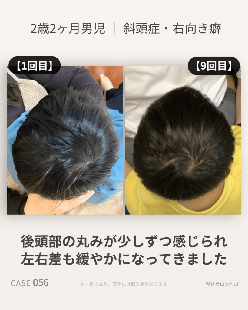 2歳2ヶ月男児の斜頭症ビフォーアフター比較