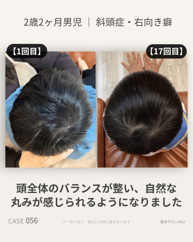 2歳2ヶ月男児の斜頭症ビフォーアフター比較