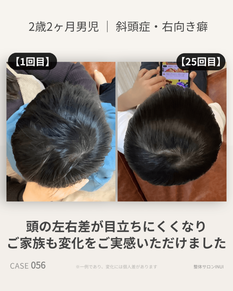 2歳2ヶ月男児の斜頭症ビフォーアフター比較