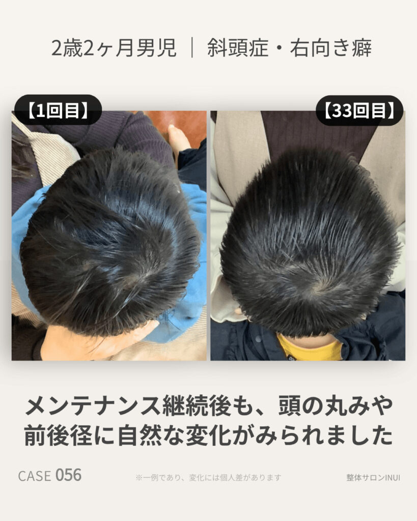 2歳2ヶ月男児の斜頭症ビフォーアフター比較