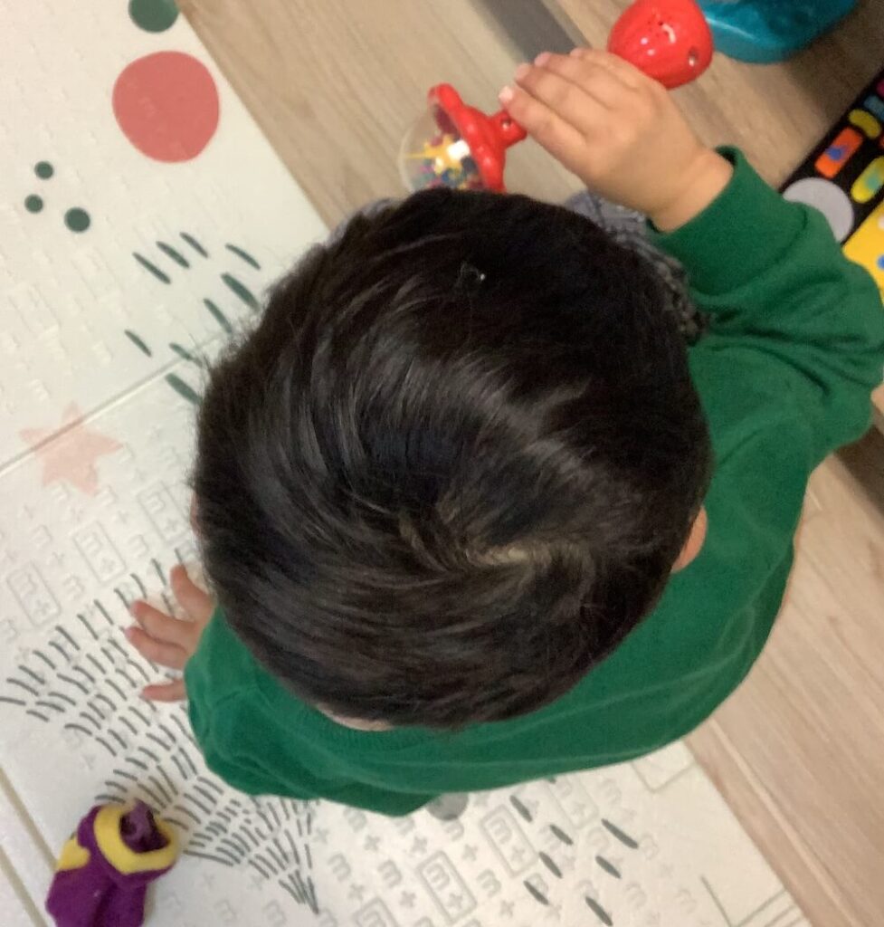 3歳5ヶ月男児の斜頭症による後頭部左右差