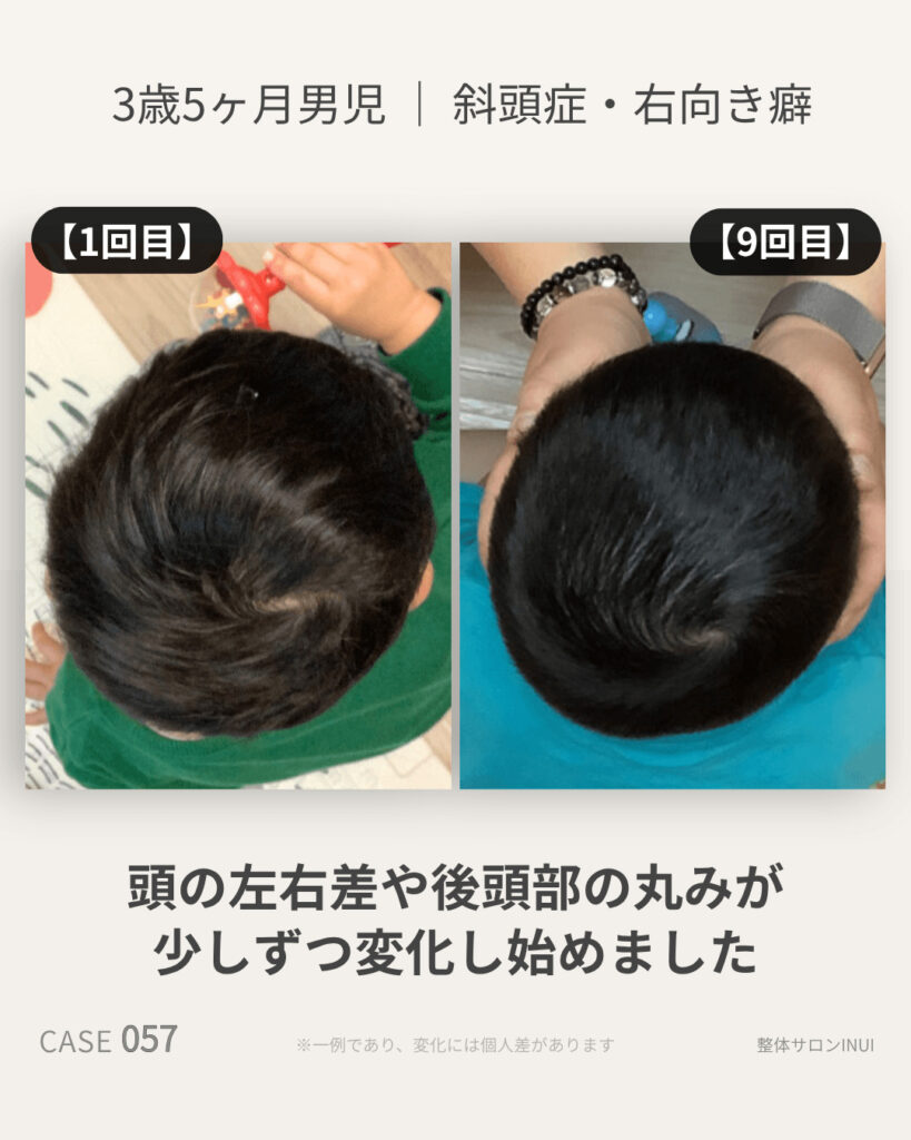 3歳5ヶ月男児の斜頭症ビフォーアフター比較