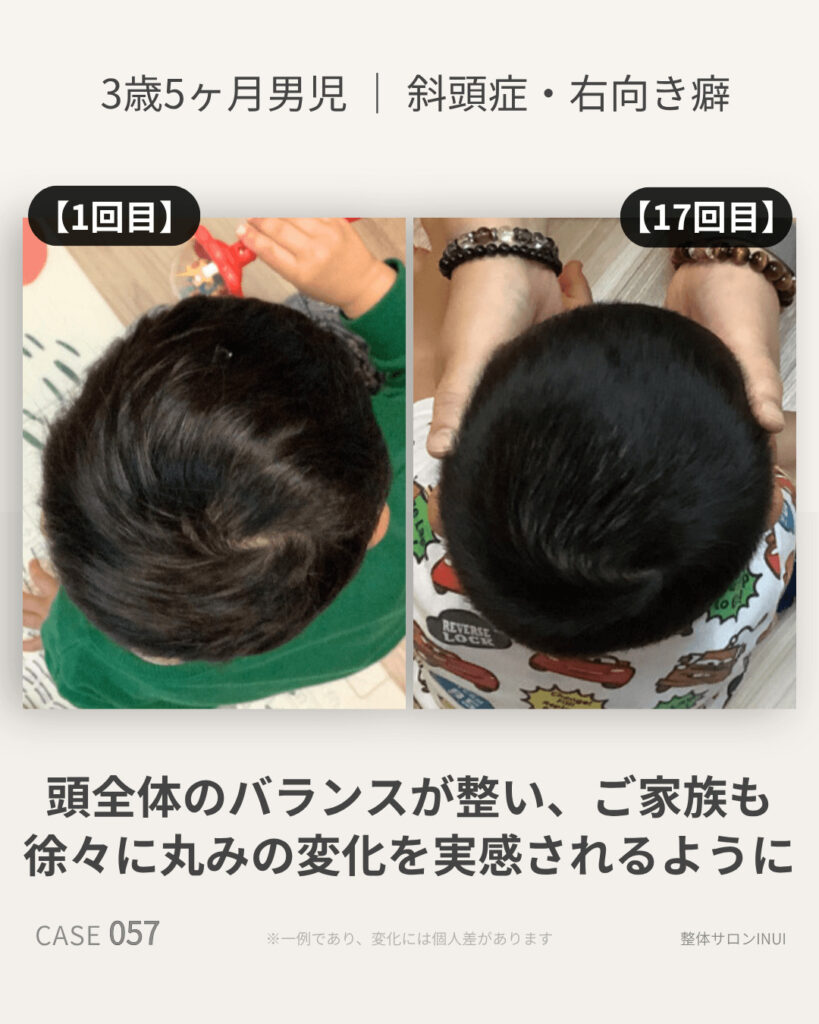 3歳5ヶ月男児の斜頭症ビフォーアフター比較