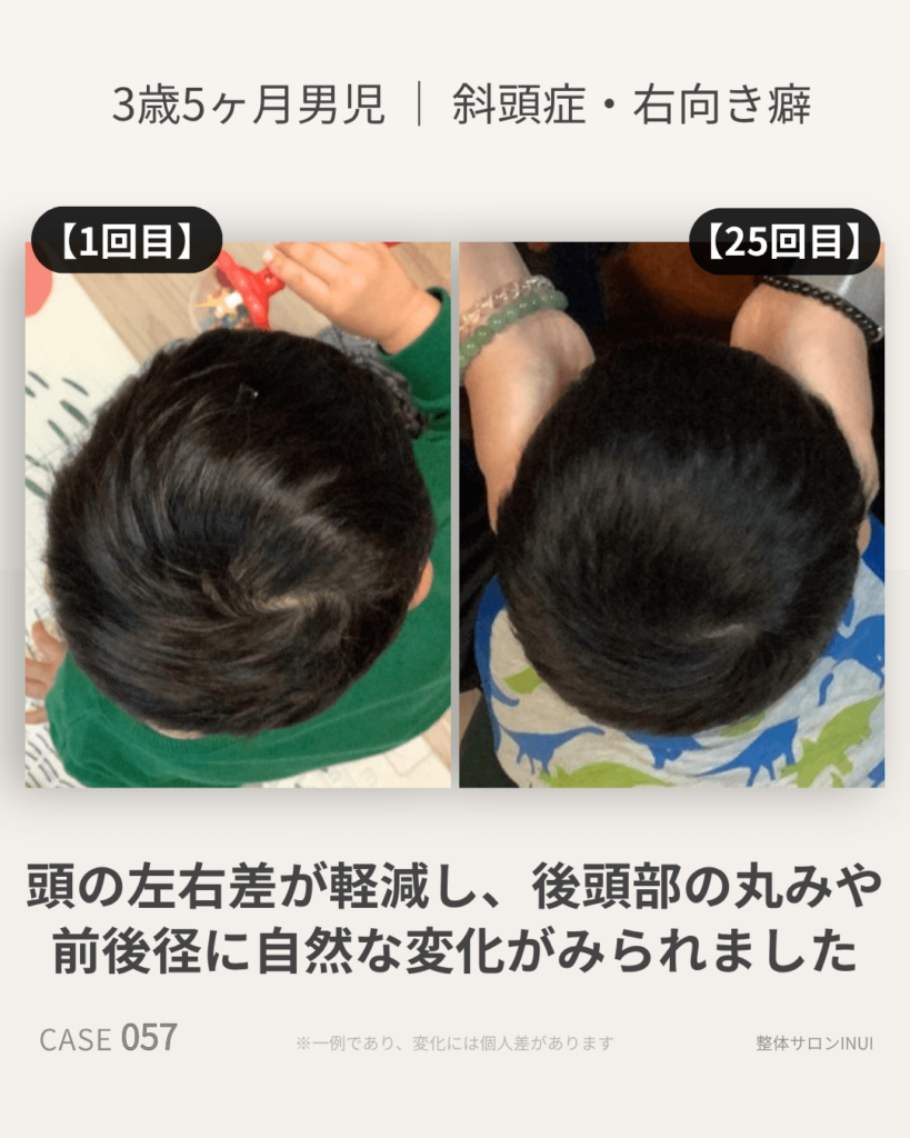 3歳5ヶ月男児の斜頭症ビフォーアフター比較