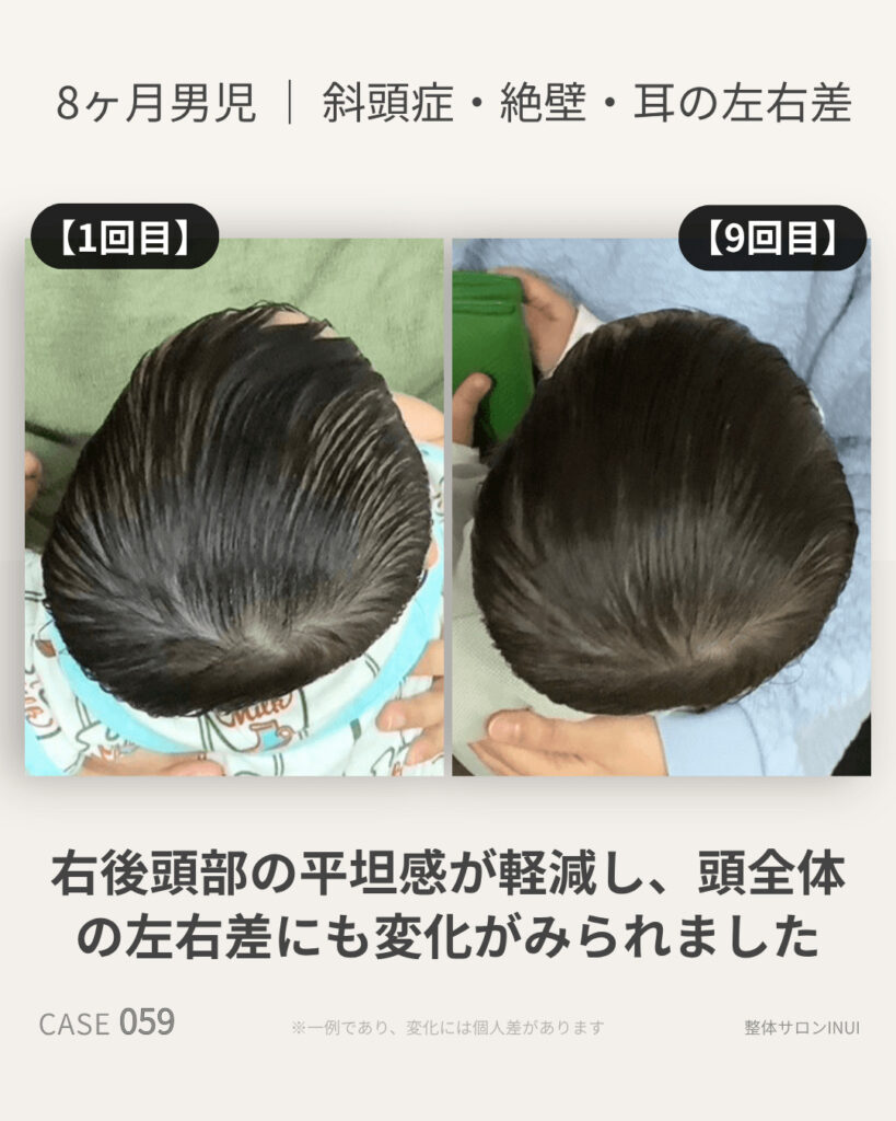 生後8ヶ月男児の斜頭症ビフォーアフター比較