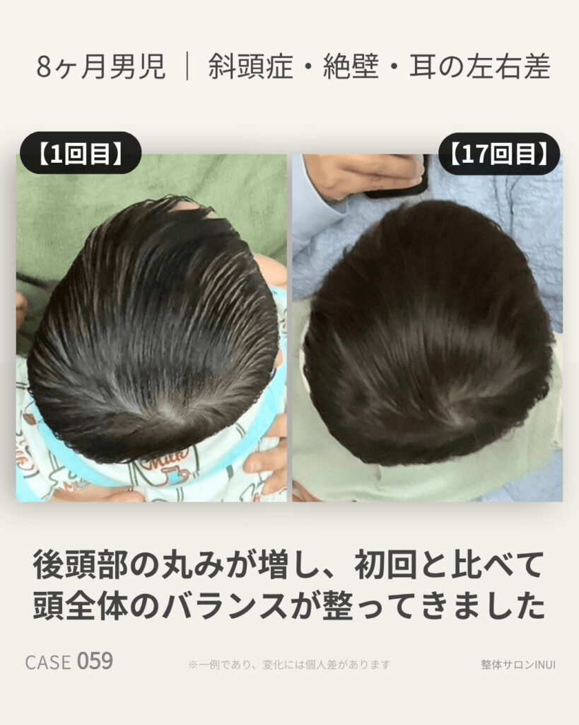 生後8ヶ月男児の斜頭症ビフォーアフター比較