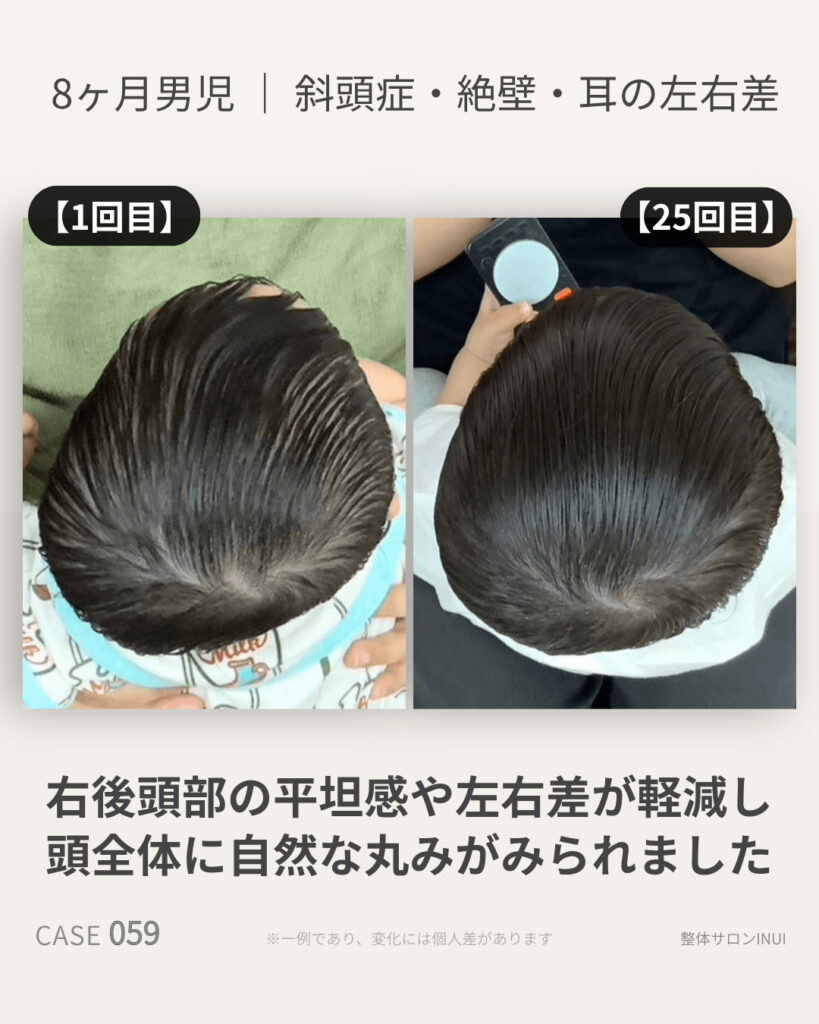 生後8ヶ月男児の斜頭症ビフォーアフター比較