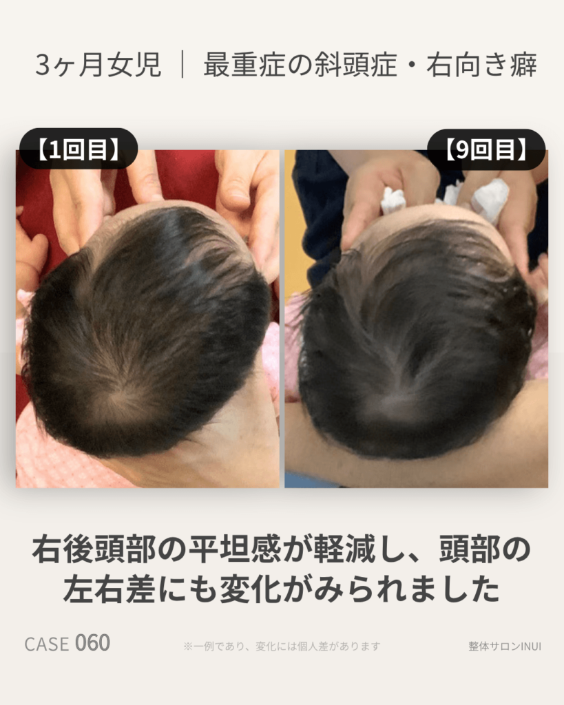 生後3ヶ月女児の斜頭症ビフォーアフター比較