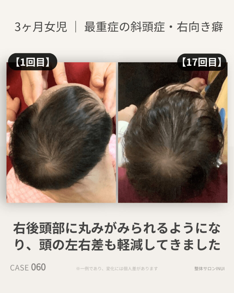 生後3ヶ月女児の斜頭症ビフォーアフター比較
