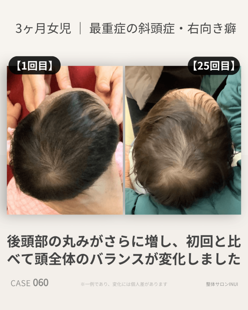 生後3ヶ月女児の斜頭症ビフォーアフター比較