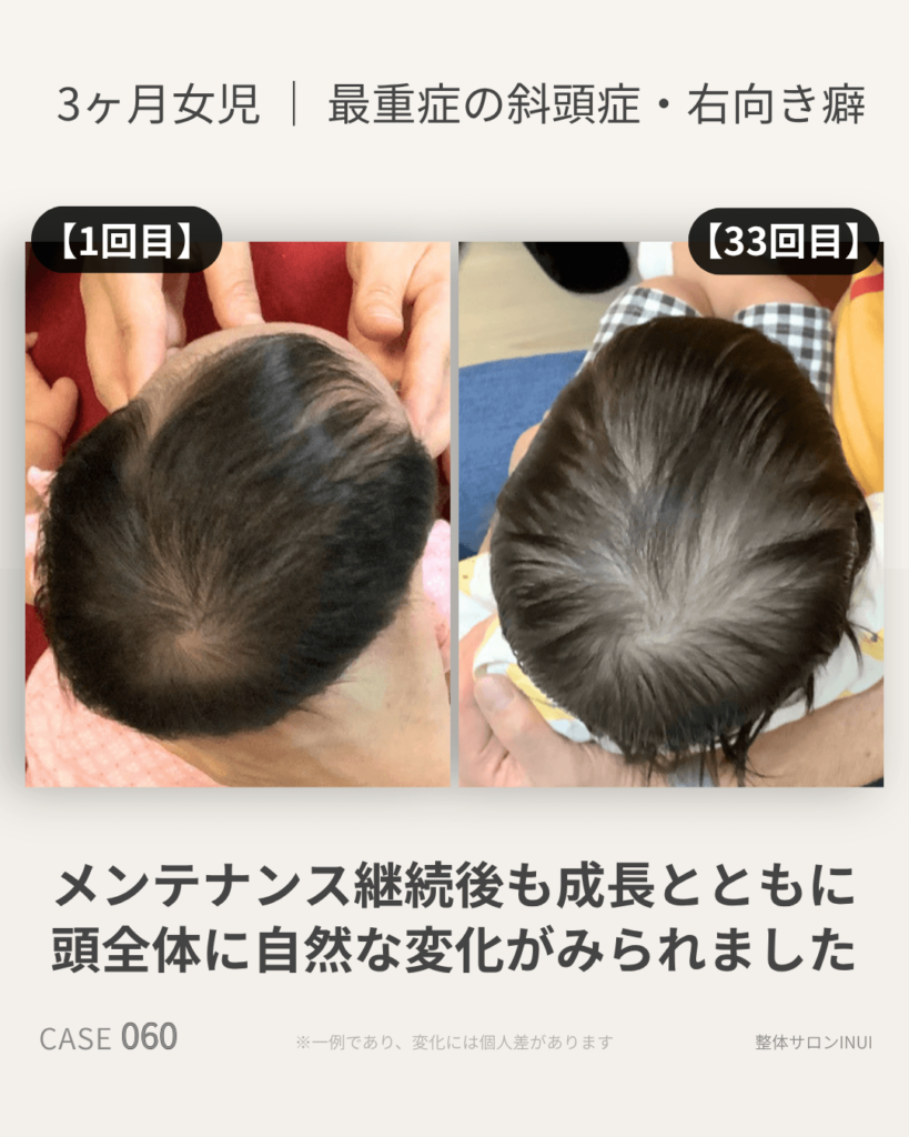 生後3ヶ月女児の斜頭症ビフォーアフター比較