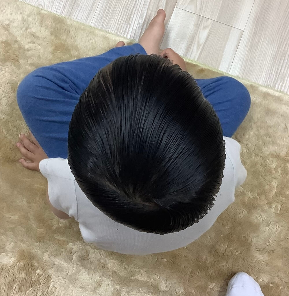 3歳5ヶ月男児の斜頭症による後頭部左右差