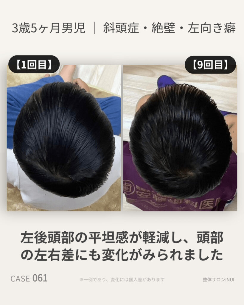 3歳5ヶ月男児の斜頭症ビフォーアフター比較