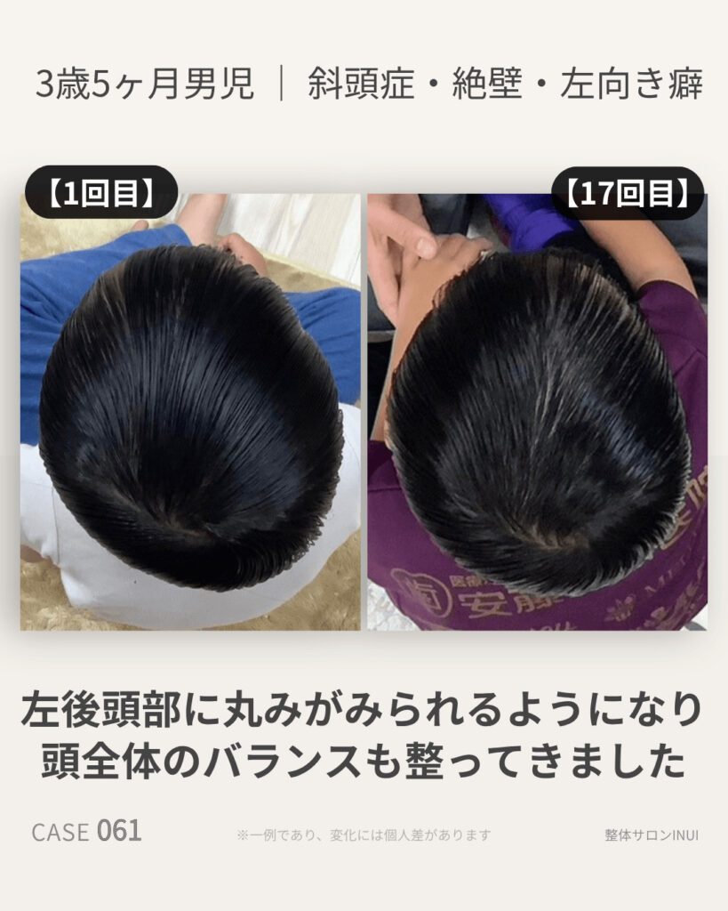 3歳5ヶ月男児の斜頭症ビフォーアフター比較