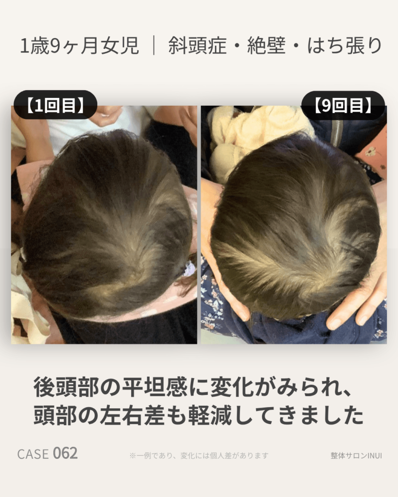 1歳9ヶ月女児の斜頭症ビフォーアフター比較