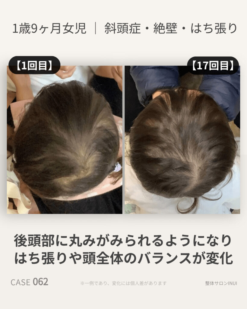 1歳9ヶ月女児の斜頭症ビフォーアフター比較