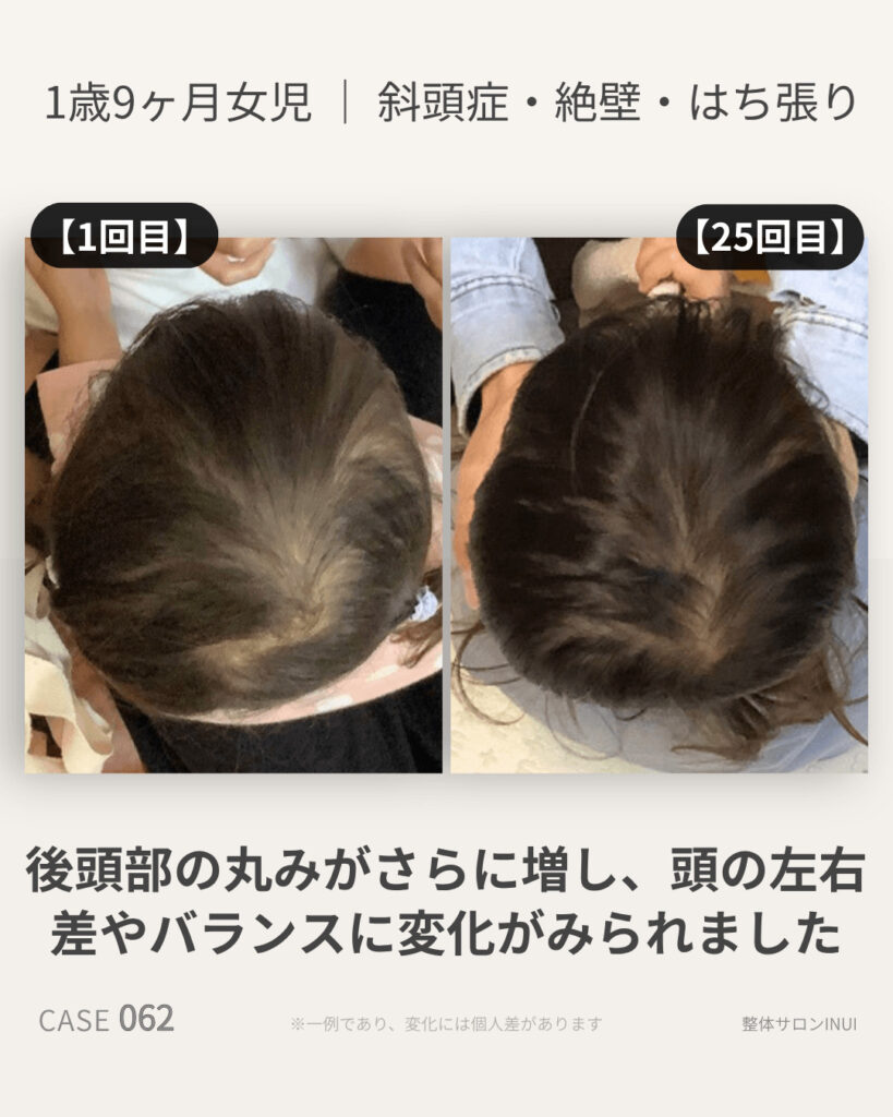 1歳9ヶ月女児の斜頭症ビフォーアフター比較