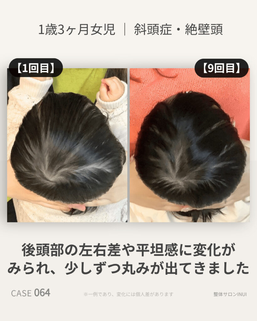 1歳3ヶ月女児の斜頭症ビフォーアフター比較
