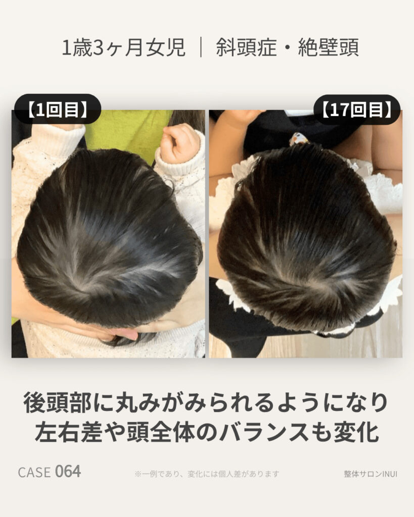 1歳3ヶ月女児の斜頭症ビフォーアフター比較