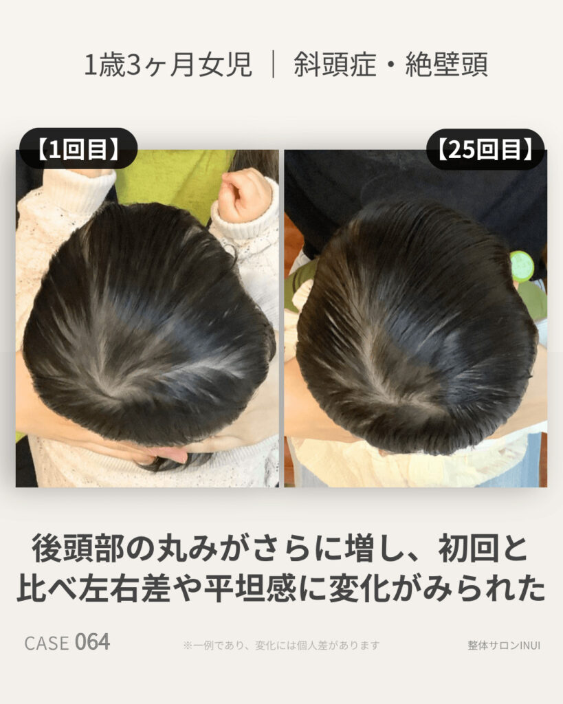 1歳3ヶ月女児の斜頭症ビフォーアフター比較