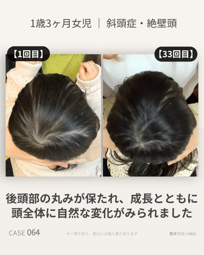 1歳3ヶ月女児の斜頭症ビフォーアフター比較