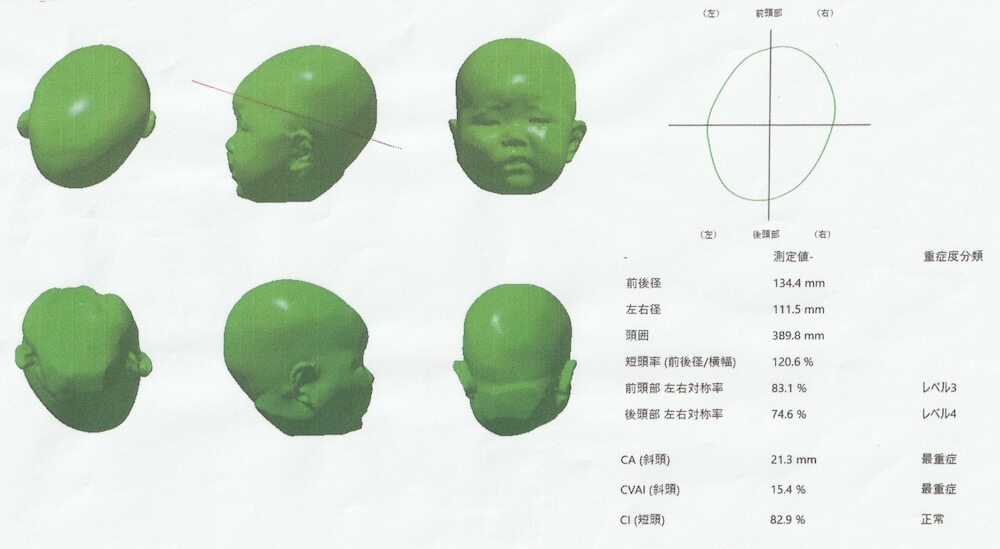 生後3ヶ月女児の斜頭症｜医療機関での頭の形の検査結果・序盤