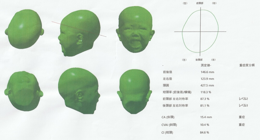 生後3ヶ月女児の斜頭症｜医療機関での頭の形の検査結果・中盤